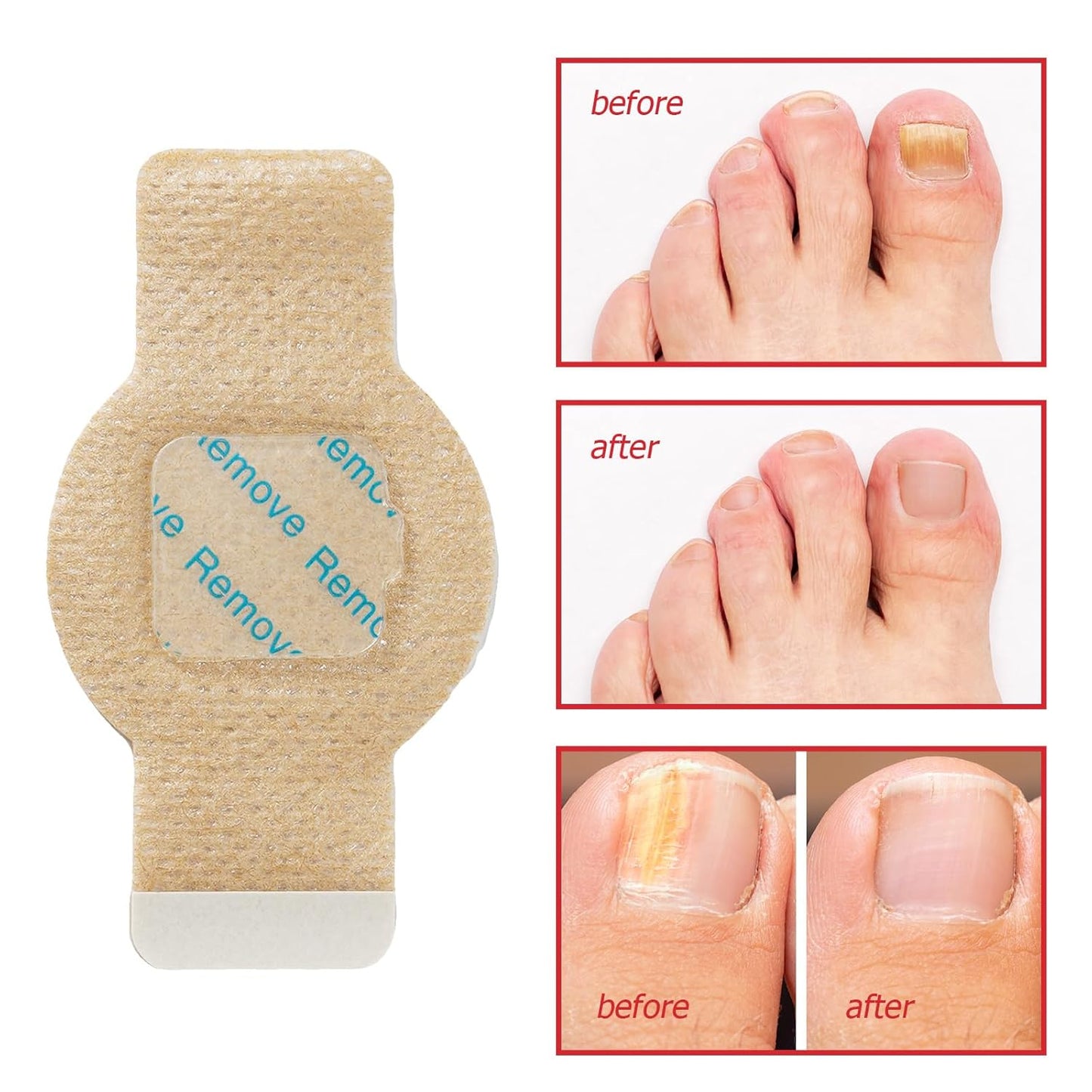 Nail Antibacterial Fungus Patch