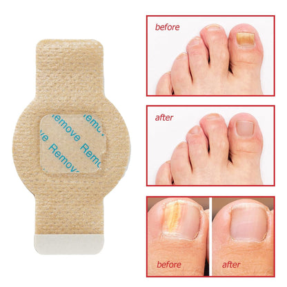 Nail Antibacterial Fungus Patch